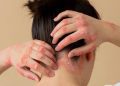 La psoriasis en adolescentes y adultos jóvenes: lo que debes saber