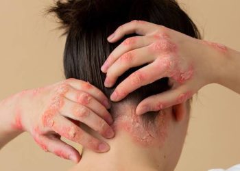 La psoriasis en adolescentes y adultos jóvenes: lo que debes saber
