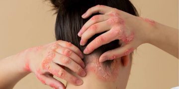 La psoriasis en adolescentes y adultos jóvenes: lo que debes saber